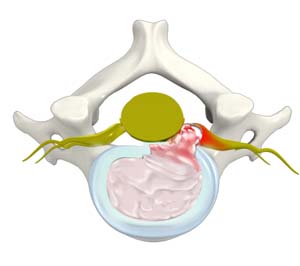 Herniated Discs