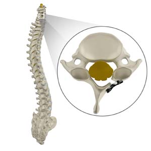 Cervical Laminoplasty