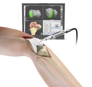 Computer Navigation for Knee Replacement