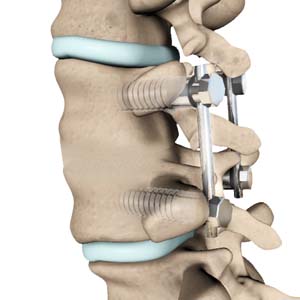 Posterior Spinal Fusion