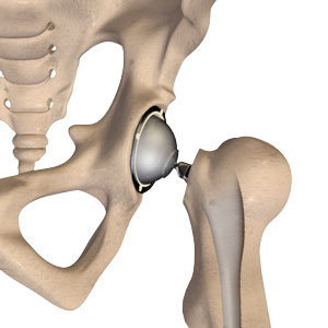 Total Hip Replacement (THR)