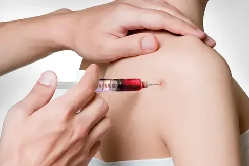 TMI Sports Medicine PRP