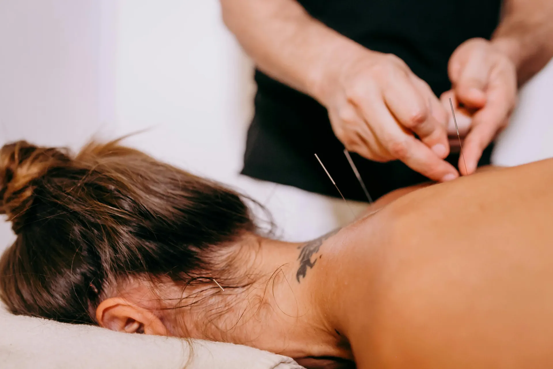 Systemic dry needling applying pressure points